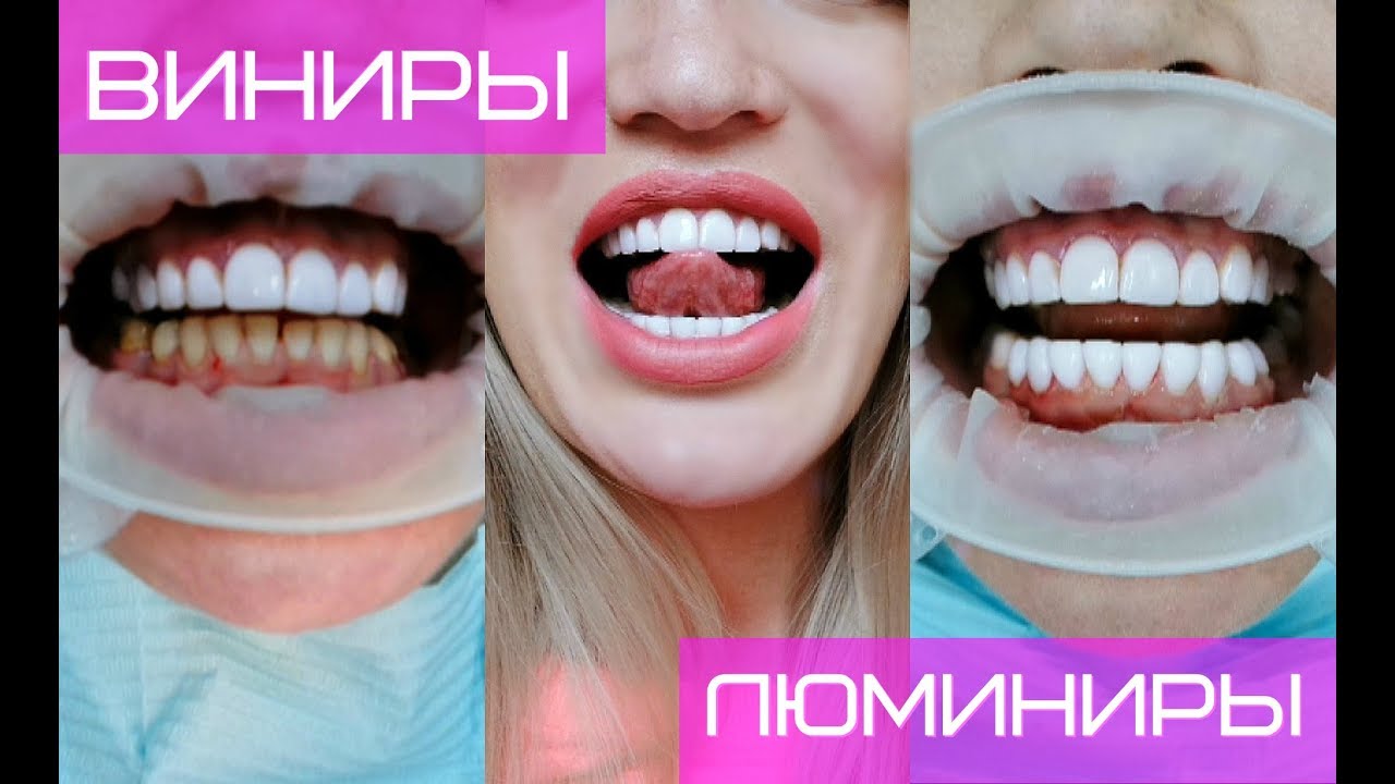Люминиры стоматология Импланты Bredent Томск Асиновская